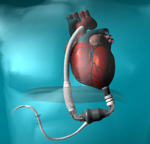 HeartmateII LVAD