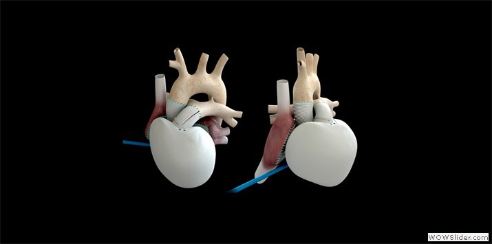 Vue d'ensemble du coeur artificiel CARMAT